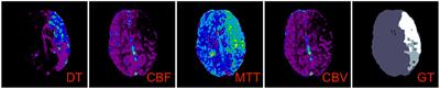 Machine learning segmentation of core and penumbra from acute stroke CT perfusion data